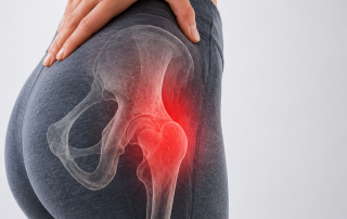 Atlaxis centro de fisioterapia y osteopatia Tratamiento fisioterapéutico de la trocanteritis y dolor lateral de cadera Atlaxis centro de fisioterapia y osteopatia